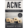 Acne: How to Cure Acne through Natural Remedies and Simple Habits. Say Goodbye to Pustules, Blackheads and Whiteheads for Good!