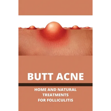 Butt Acne: Home And Natural Treatments For Folliculitis: Barber'S Itch Home Remedies