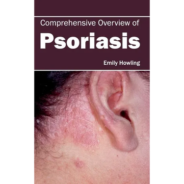 Comprehensive Overview of Psoriasis