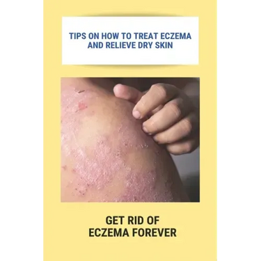 Tips On How To Treat Eczema And Relieve Dry Skin: Get Rid Of Eczema Forever: Overcome Eczema
