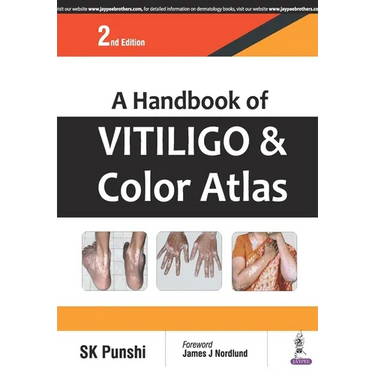 A Handbook of Vitiligo and Color Atlas