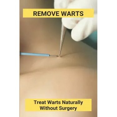 Remove Warts: Treat Warts Naturally Without Surgery: Boost Immune System To Get Rid Of Warts