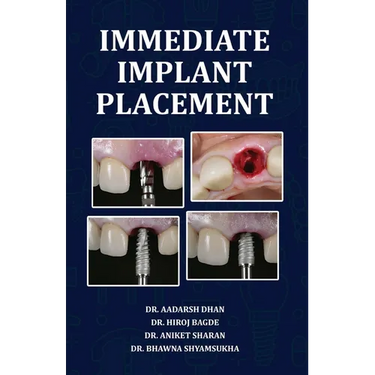 Immediate Implant Placement