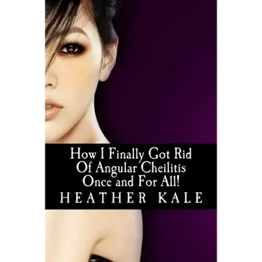 How I Finally Got Rid Of Angular Cheilitis Once and For All!: Cracked Mouth Corners No More