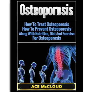 Osteoporosis: How To Treat Osteoporosis: How To Prevent Osteoporosis: Along With Nutrition, Diet And Exercise For Osteoporosis