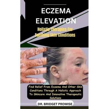 Eczema Elevation: Holistic Therapies For Soothing Skin Conditions: Find Relief From Eczema And Other Skin Conditions Through A Holistic