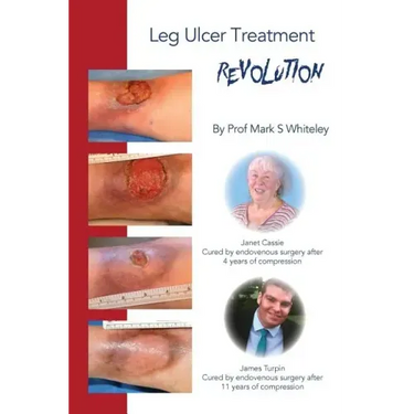 Leg Ulcer Treatment Revolution