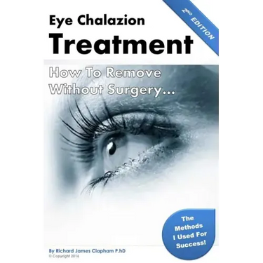Eye Chalazion: How To Remove Without Surgery: My personal experience and the methods I used for success