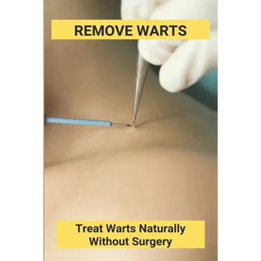 Remove Warts: Treat Warts Naturally Without Surgery: Boost Immune System To Get Rid Of Warts