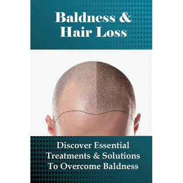 Baldness & Hair Loss: Discover Essential Treatments & Solutions To Overcome Baldness: How To Prevent Hair Loss For Guys