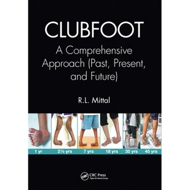 Clubfoot: A Comprehensive Approach (Past, Present, and Future)