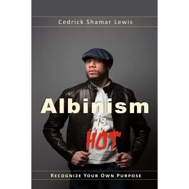 Albinism is Hot!