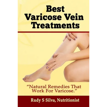 Best Varicose Vein Treatments: Natural Remedies That Work for Varicose