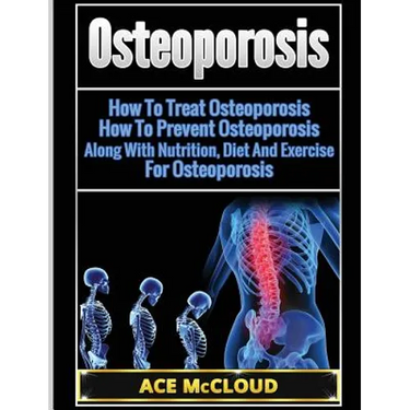 Osteoporosis: How To Treat Osteoporosis: How To Prevent Osteoporosis: Along With Nutrition, Diet And Exercise For Osteoporosis