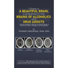 I Have a Beautiful Brain, Compared to the Brains of Alcoholics and Drug Addicts