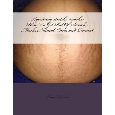 Agonizing stretch marks-How To Get Rid Of Stretch Marks: Natural Cures and Remedi