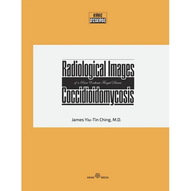 Radiological Images of a Rare Endemic Fungal Disease Coccidioidomycosis
