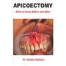 Apicoectomy: What to Know Before and After