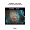 Metaplastic Breast Cancer: Overview and guide to the physicians