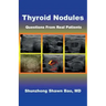 Thyroid Nodules: Questions From Real Patients