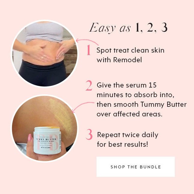 ReModel Serum: Stretch Mark Treatment by The Spoiled Mama
